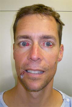 Adam-Parer-haemotoma-eyes Adam Parer five days after the hang glider accident. The haemotoma in his eyes is beginning to heal.