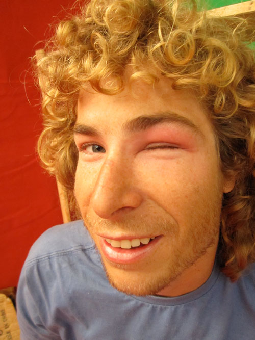 An antic... Ant Green, XCmag's resident acro pilot, suffers extreme eye reaction to a bee sting An antic... Ant Green, XCmag's resident acro pilot, suffers extreme eye reaction to a bee sting